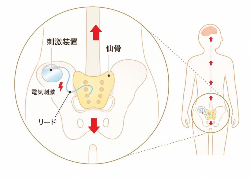仙骨神経刺激療法(SNM)の仕組み