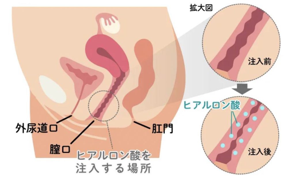 膣ヒアルロン酸注入 注入前・注入後