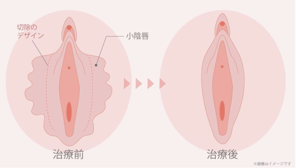 小陰唇縮小術 治療前・治療後