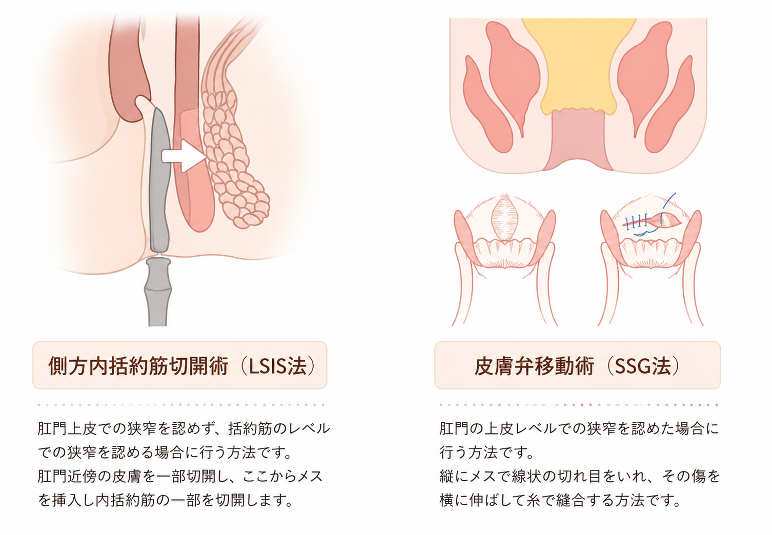 側方内括約筋切開術（LSIS法）・皮膚弁移動術（SSG法）の図