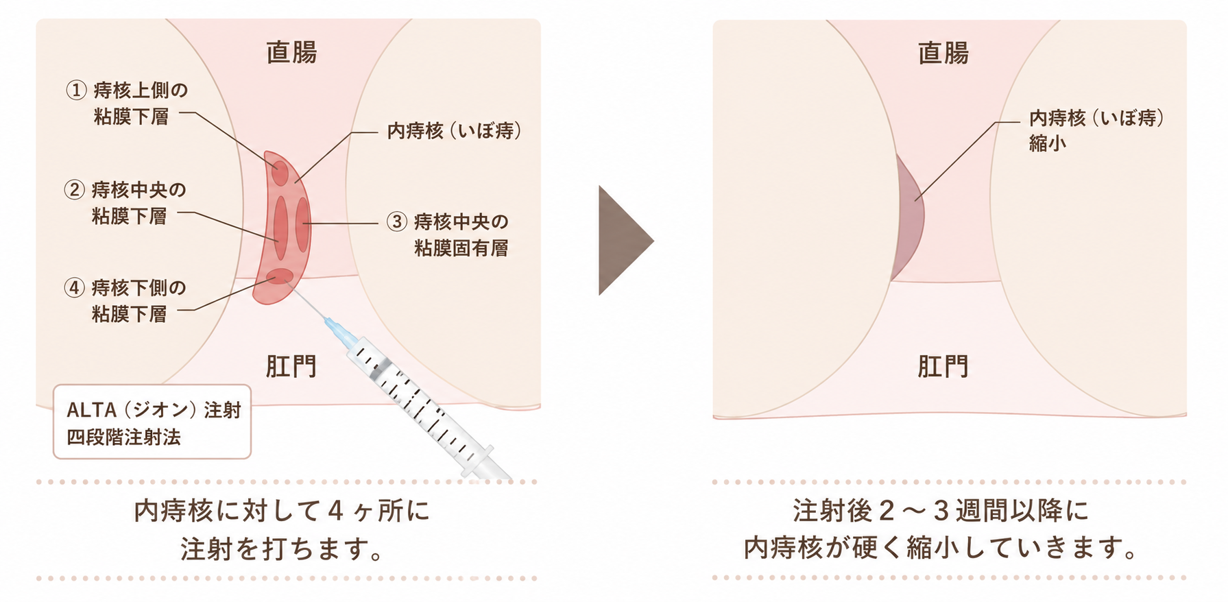 ジオン注射（ALTA）の図