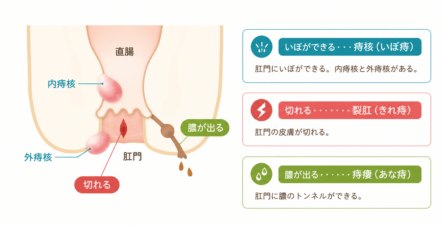 痔の分類図