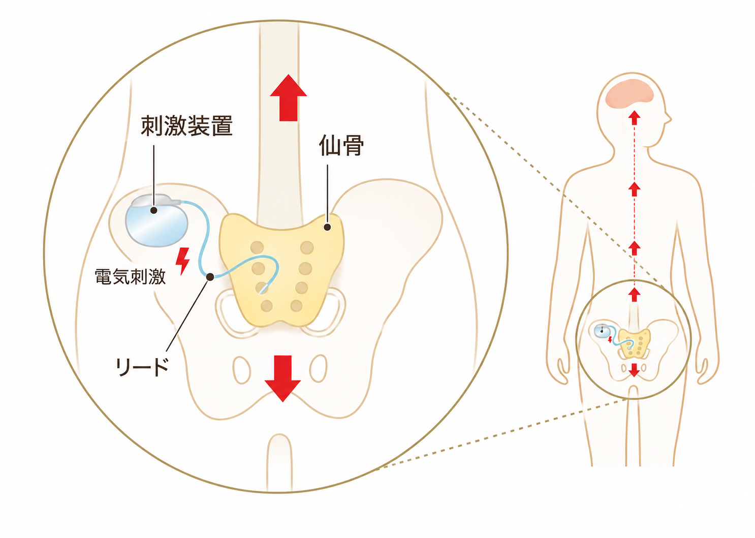 仙骨神経刺激療法（SNM）の図