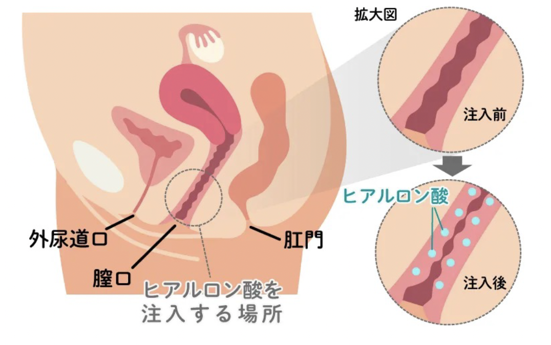膣ヒアルロン酸 注入部位