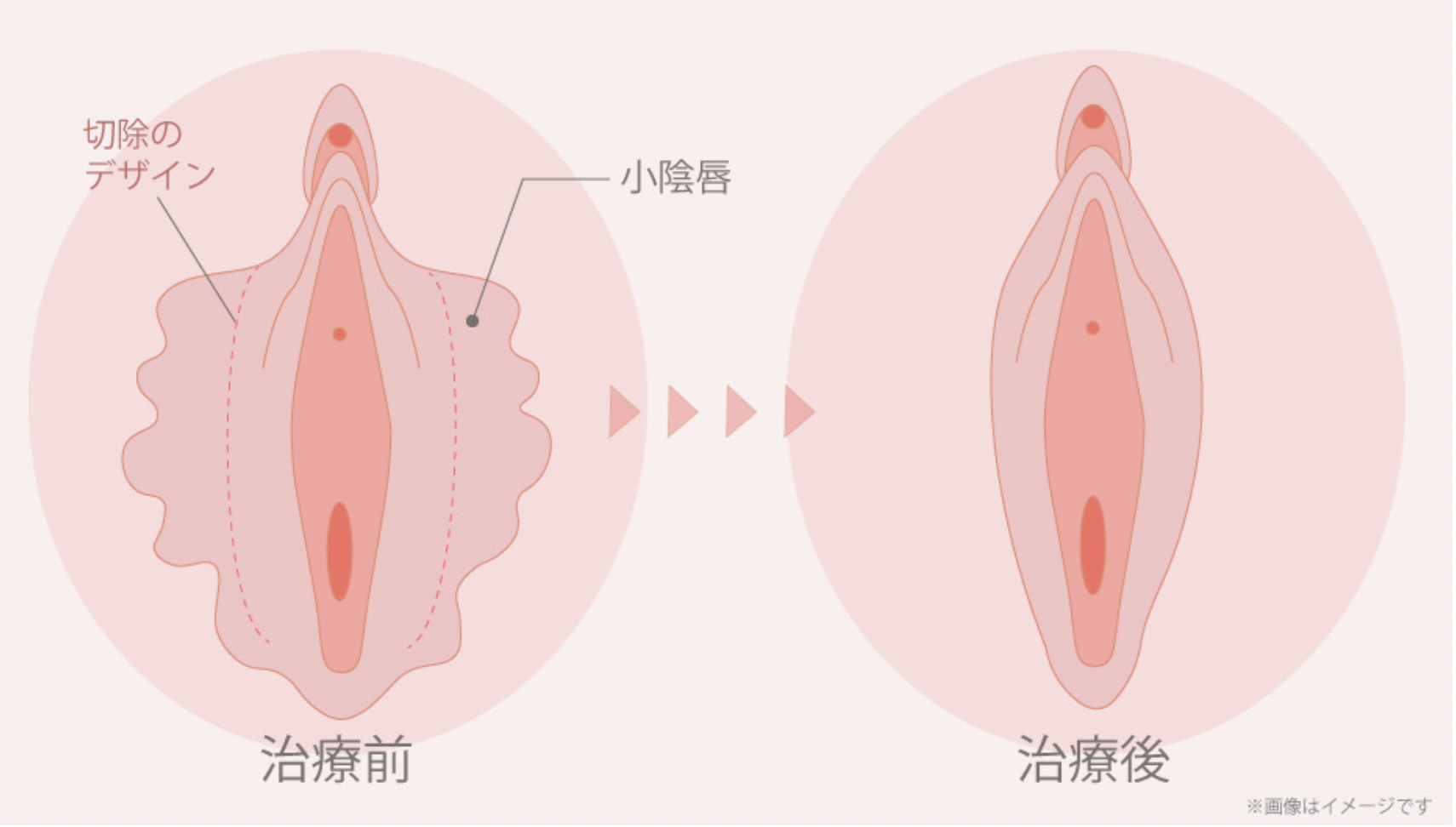 小陰唇縮小術 治療前・治療後